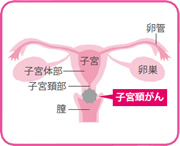 子宮頚がんの場所を示すイラスト図