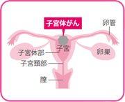 子宮対がんの場所を示すイラスト図
